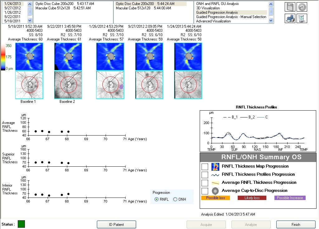 Analyse de progression OCT