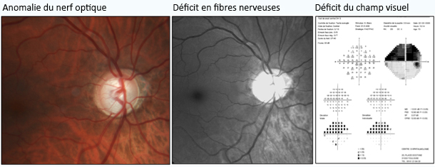 glaucome_severe