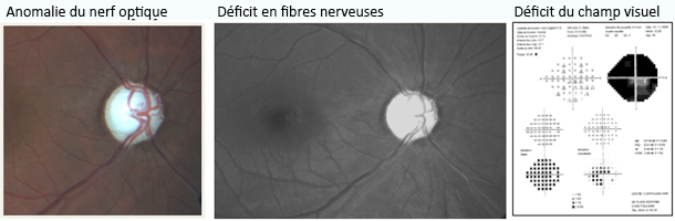 glaucome_terminal