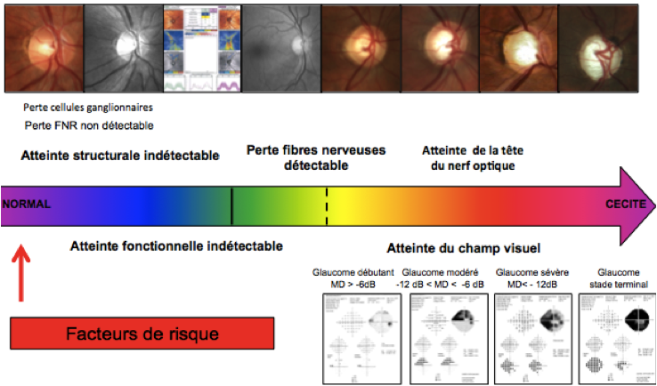 Histoire naturelle du glaucome